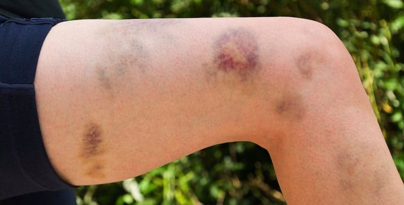 ITP or Idiopathic Thrombocytopenic Purpura is a bleeding disorder.It is a rare problem, which is characterized by decreased platelets in the body.